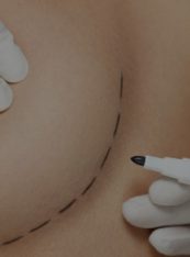 Breast Augmentation