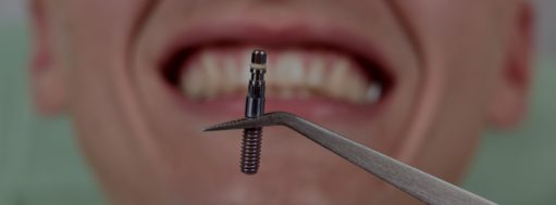 Dental Implants For One Tooth