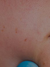 Laser Therapy for Scar