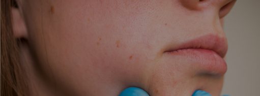 Laser Therapy for Scar