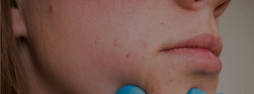 Laser Therapy for Scar