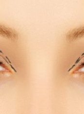 Eyelid Surgery