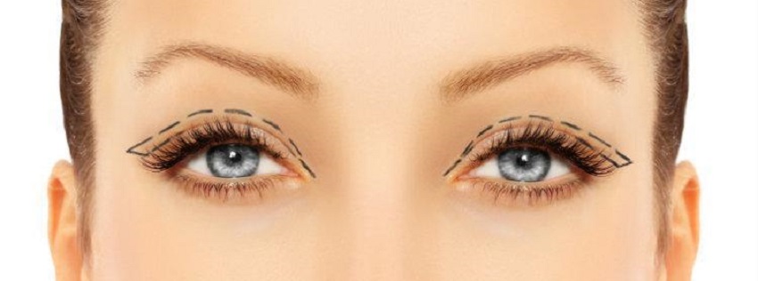 Eyelid Surgery