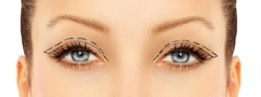 Eyelid Surgery