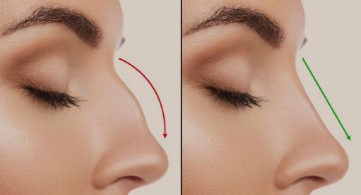 Nose job