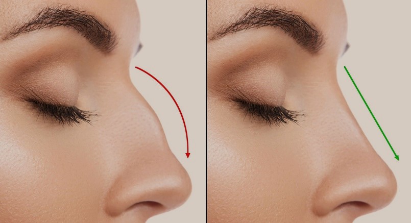 Nose job