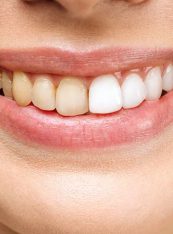 Discolored Teeth, Yellow Teeth, Tooth, Teeth Whitening, Dentistry, Orthodontics, Whitening Strips