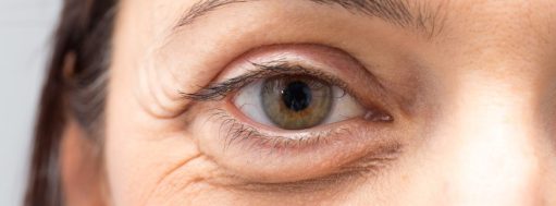 Under eye bags, Puffy eye bags, Restlessness, Baggy eyes, Blepharoplasty, Surgery