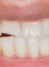 Chipped Teeth, Broken Tooth, Dentistry, Orthodontics