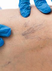 Spider Veins on leg, Varicose veins