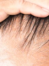 Hair Loss, Balding, Forehead, Hair Transplant, Hair Restoration