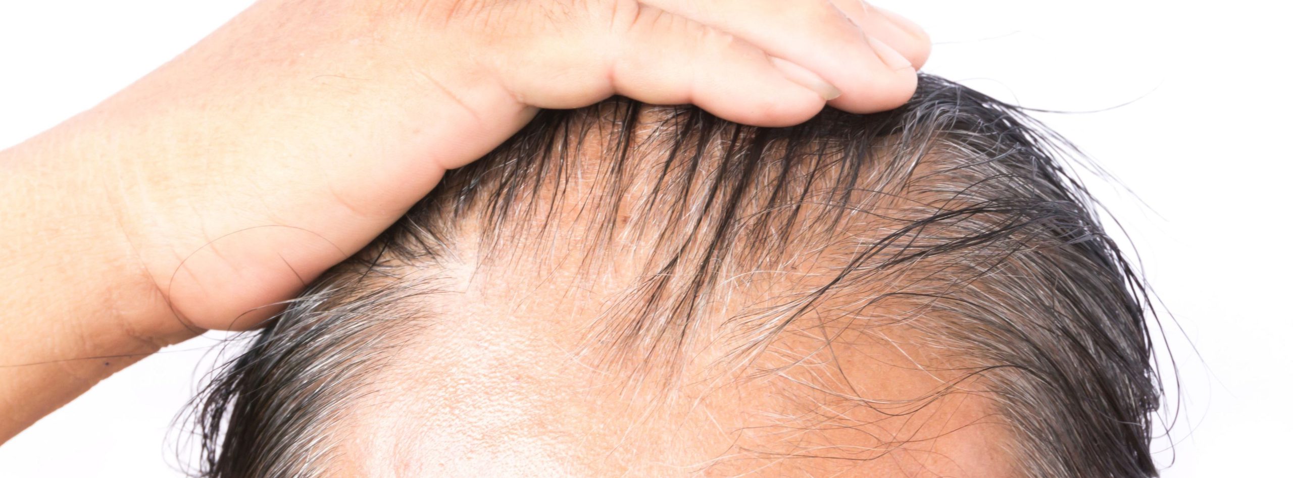 Hair Loss, Balding, Forehead, Hair Transplant, Hair Restoration