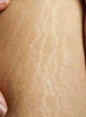 Stretch Marks medspa