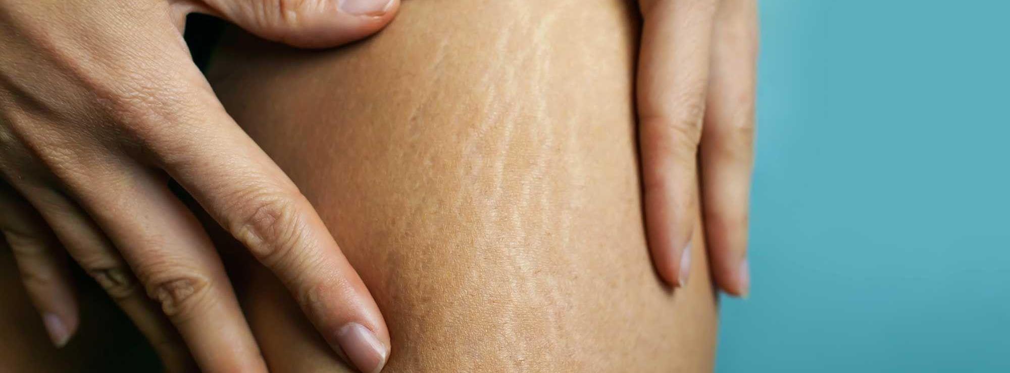 Stretch Marks medspa