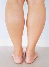 Calf Liposuction