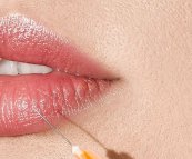 Lip Augmentation