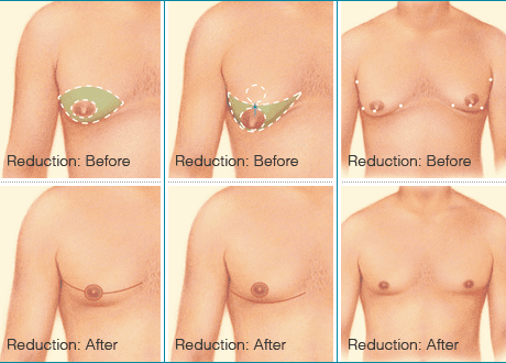 Male Breast Reduction