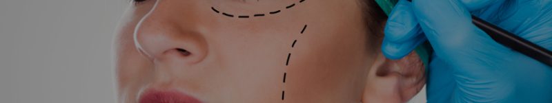 Facelift