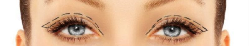 Eyelid Surgery