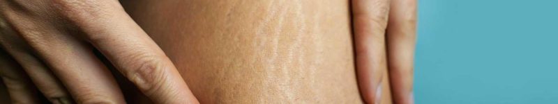 Stretch Marks medspa